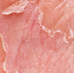 Kulit Kering Menggelupas